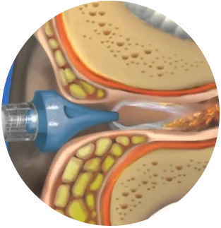 Ear Irrigation or Syringing